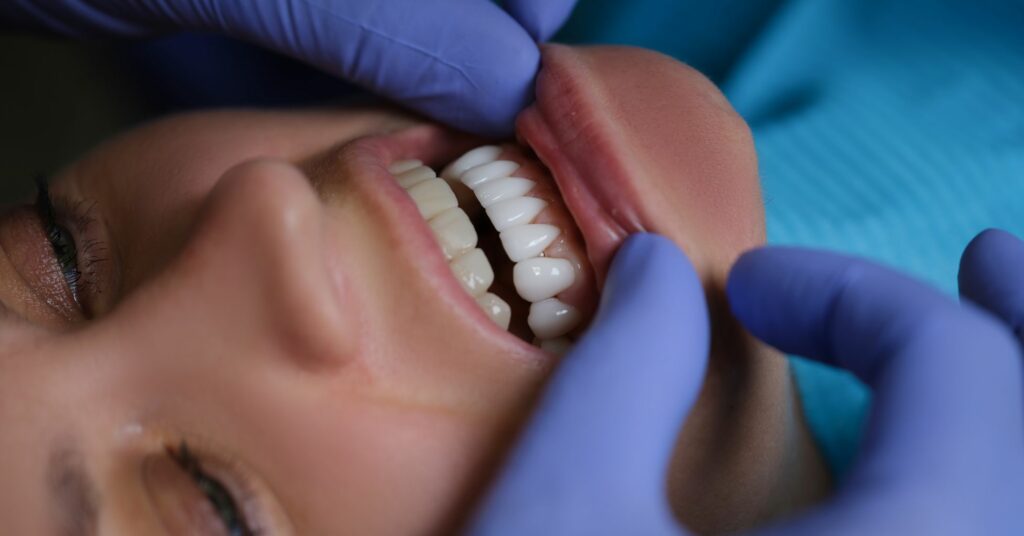 faccette dentali inferiori