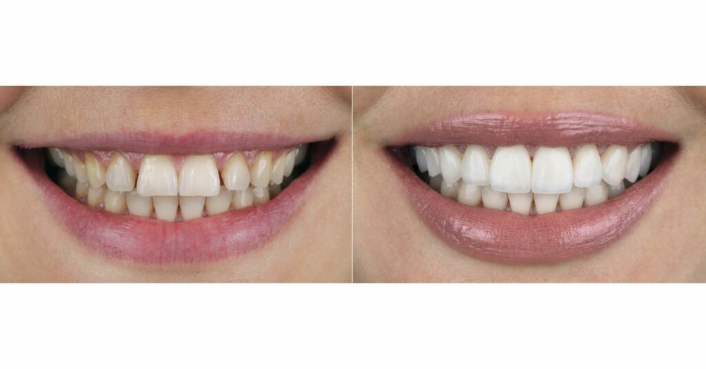 faccette dentali prima e dopo