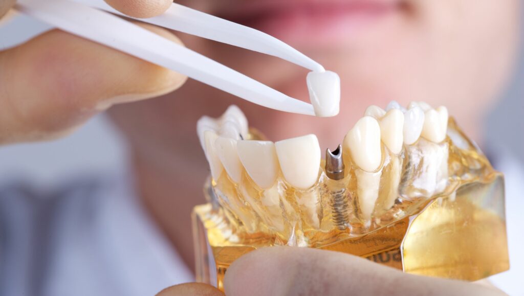 impianto dentale con applicazione corona dentale in zirconio
