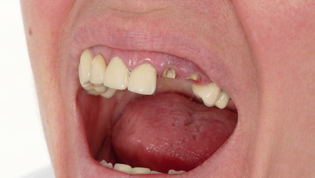 denti rotti