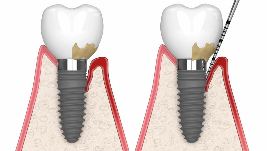 sondaggio della perimplantite