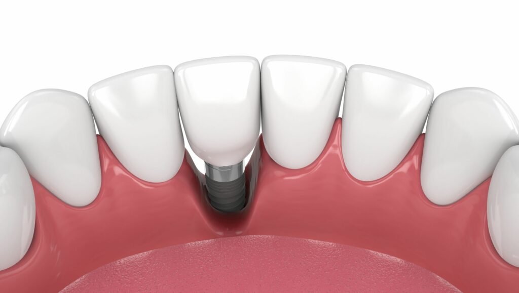 perimplantite incisivo