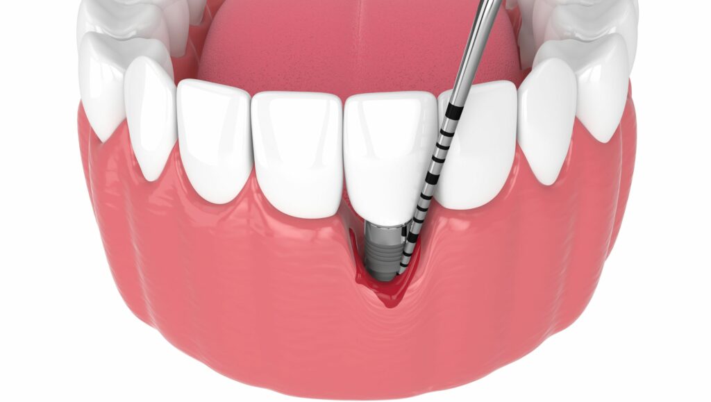 sondaggio per la perimplantite con sonda calibrata