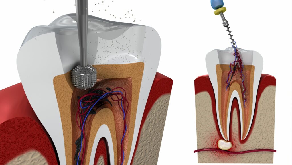 Preparazione per la devitalizzazione del dente